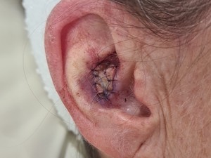 Basal cell cancer skin graft