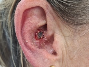 basal cell cancer on ear