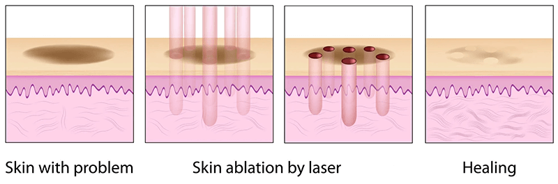 Scar Revision