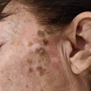 seborrheic keratosis