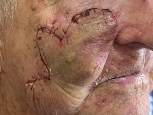 Squamous cell cancer - 2 weeks post op