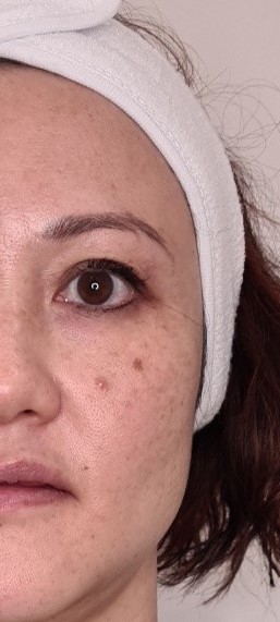 flat seborrheic keratosis under eye